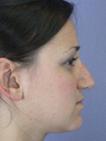 Nose Reshaping Before and after photo