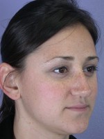 Nose Reshaping Before and after photo