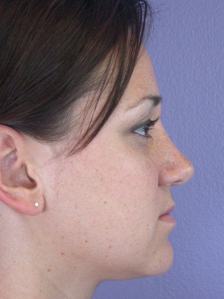 Nose Reshaping before and after photo