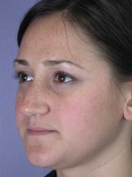 Nose Reshaping Before and after photo