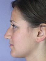 Nose Reshaping Before and after photo