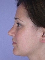 Nose Reshaping Before and after photo