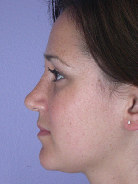 Nose Reshaping before and after photo