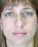 Nose Reshaping Before and after photo