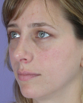 Nose Reshaping before and after photo