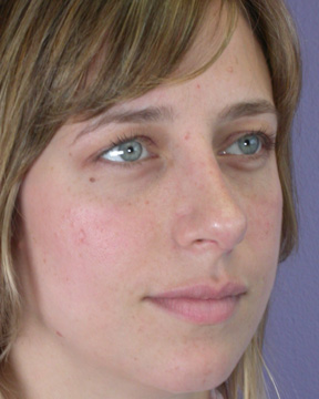 Nose Reshaping before and after photo