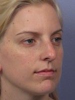 Nose Reshaping Before and after photo