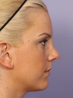 Nose Reshaping Before and after photo