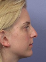 Nose Reshaping Before and after photo