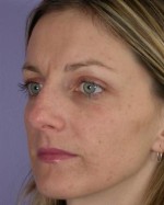 Nose Reshaping Before and after photo