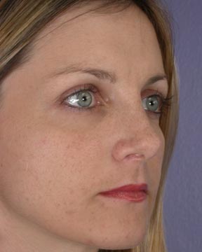 Nose Reshaping before and after photo