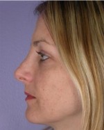 Nose Reshaping Before and after photo