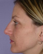 Nose Reshaping Before and after photo