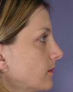 Nose Reshaping Before and after photo