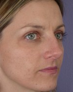 Nose Reshaping Before and after photo