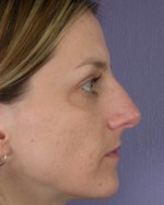 Nose Reshaping Before and after photo