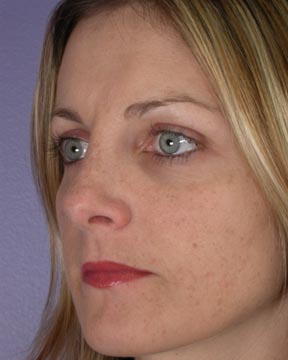 Nose Reshaping before and after photo