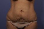 Tummy Tuck Before and after photo