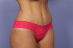 Tummy Tuck Before and after photo