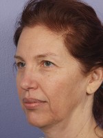 Facelift Before and after photo