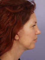 Facelift Before and after photo