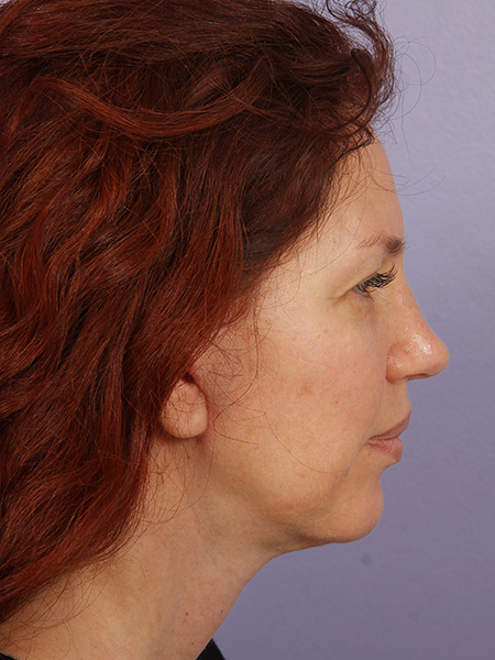 Facelift before and after photo