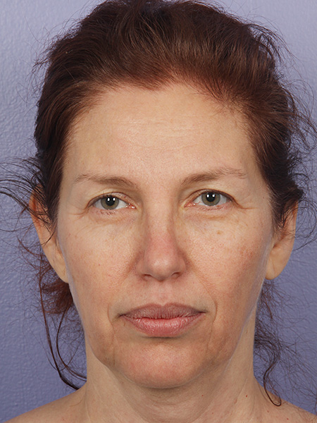 Facelift before and after photo