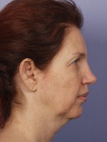 Facelift Before and after photo