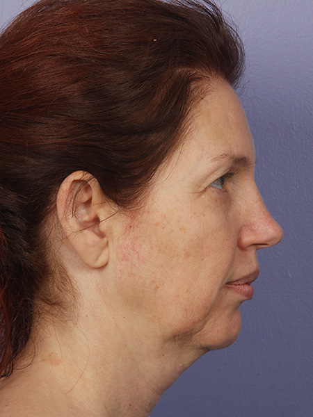 Facelift before and after photo