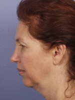 Facelift Before and after photo