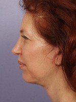 Facelift Before and after photo