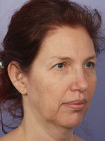 Facelift Before and after photo