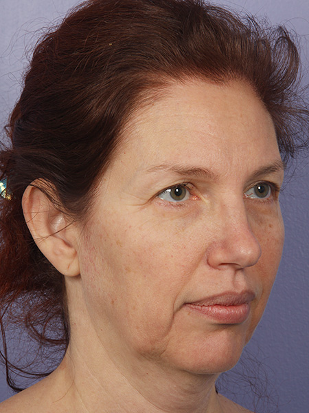 Facelift before and after photo