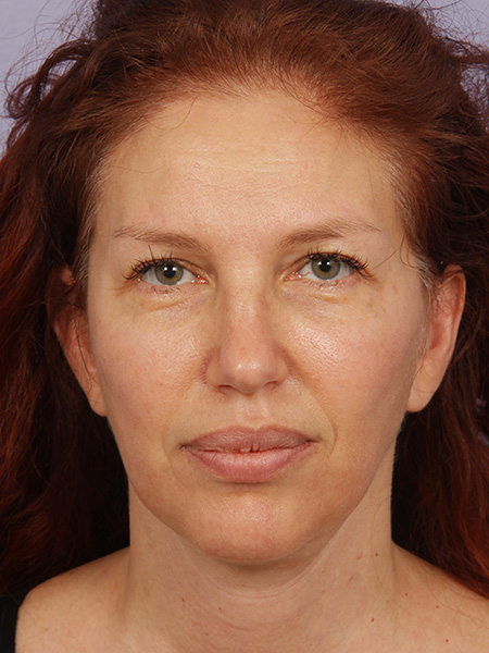 Facelift before and after photo