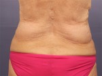 CoolSculpting® Before and after photo