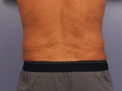 CoolSculpting® before and after photo