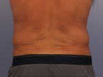 CoolSculpting® Before and after photo