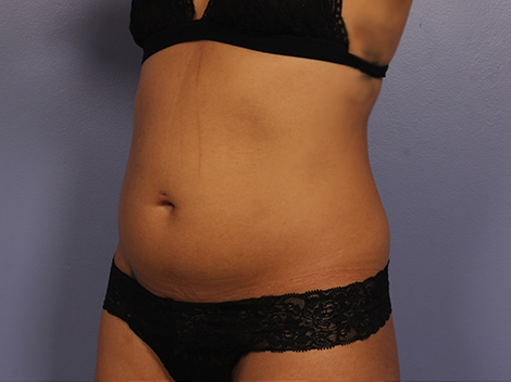 CoolSculpting® before and after photo