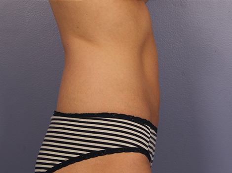 CoolSculpting® before and after photo