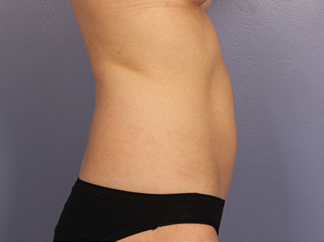 CoolSculpting® before and after photo