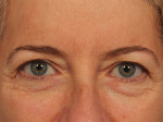 Injectable Fillers Before and after photo