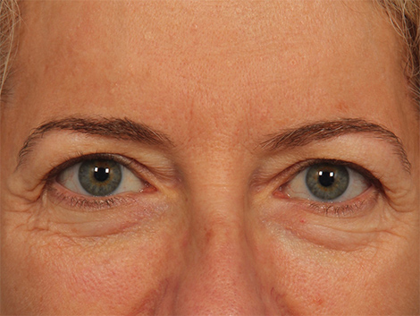 Injectable Fillers before and after photo