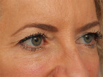 Injectable Fillers Before and after photo