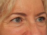 Injectable Fillers Before and after photo