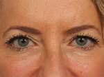 Injectable Fillers Before and after photo