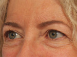 Injectable Fillers Before and after photo