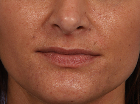 Lip Augmentation before and after photo