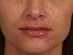 Lip Augmentation Before and after photo