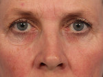 Injectable Fillers Before and after photo