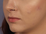 Lip Augmentation Before and after photo